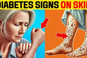 Your Skin Is Warning You About Diabetes (Don’t Ignore These 5 Signs)