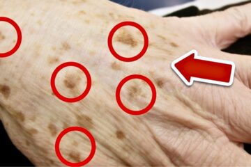 SENIORS, PLEASE! Rub This Once and Watch Age Spots Vanish Forever