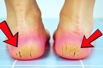 Your Cracked Heels Aren’t Just Dry Skin — Here’s the Real Cause (and Fix)